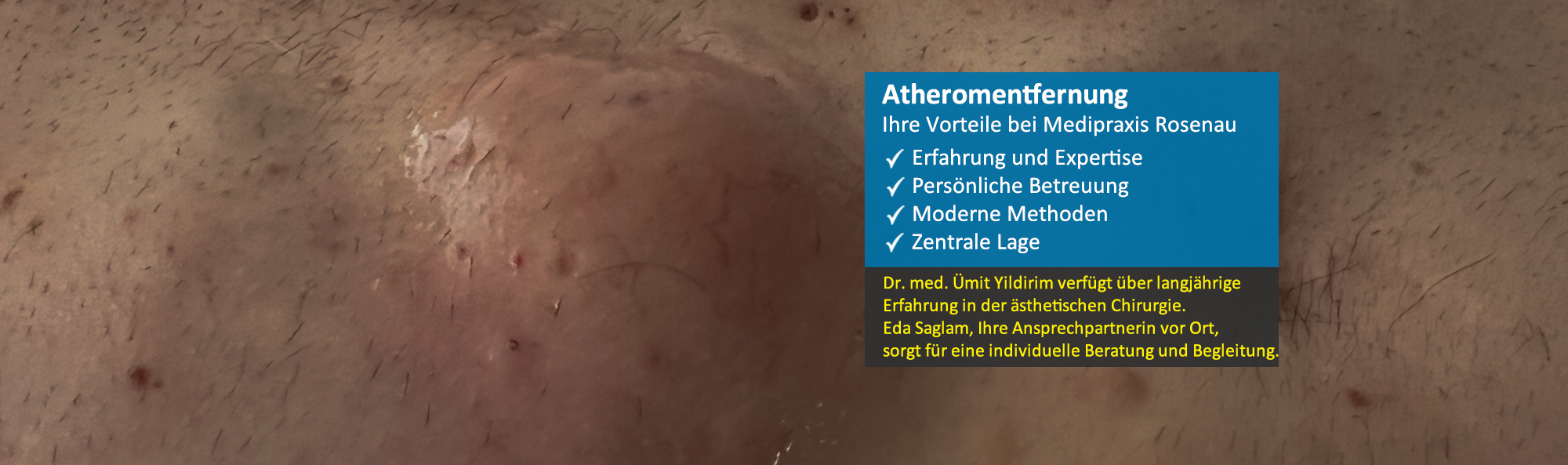 Atherom Entfernen